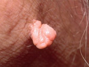 vaginal skin tag